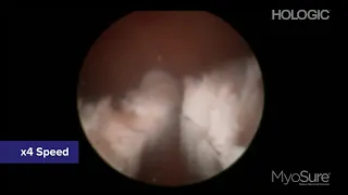 MyoSure XL Fibroid under local anaesthesia