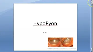 Ophthalmology 112 a HypoPyon Anterior Chamber Eye