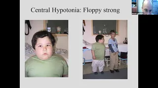 Floppy child Neurology Webinar