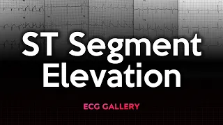 ST-Segment Elevation: ECG Gallery