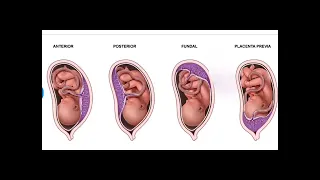 Anterior Placenta means baby Girl or Boy |Posterior Placenta means baby Girl or Boy |PlacentaPrevia