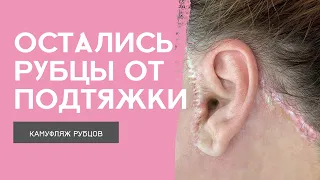 РУБЦЫ ПОСЛЕ ПОДТЯЖКИ ЛИЦА | Шрамы после пластической операции | Камуфляж рубцов после подтяжки