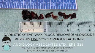 STICKY EAR WAX REMOVAL - EP 329