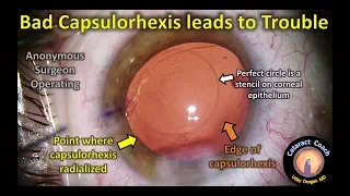 Anonymous Surgeon's Bad Capsulorhexis leads to Trouble during Cataract Surgery