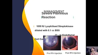 TASS vs Endophthalmitis - Clinical pearls and early management tips - Dr. Meena Chakrabarti