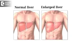 How long will it take for an inflamed liver to heal? - Dr. Nanda Rajaneesh