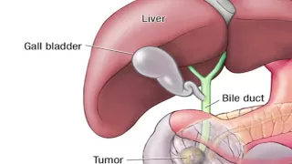 What is the Whipple Procedure - Mayo Clinic