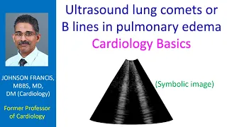 Ultrasound lung comets or B lines in pulmonary edema – Cardiology Basics