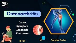 Osteoarthritis - Cause, Symptoms, Treatment | Management and Exercises | Sedative Doctor