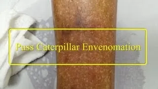 Puss Caterpillar Envenomation