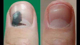 90 days in 40 seconds. Time Lapse Video Of My Nails Healing