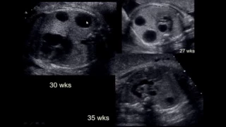 Fetal Thorax ultrasound