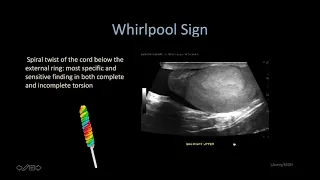 Testicular torsion