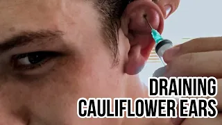 Draining my cauliflower ears with a syringe.