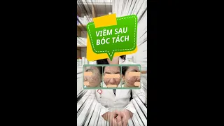 😱VIÊM SAU BÓC TÁCH SẸO?!😱