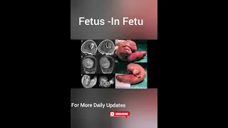 Fetus - in fetu Rare Cause in New born babies | Fetus in Fetu