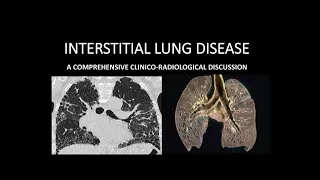 INTERSTITIAL LUNG DISEASE PART-1 [INTRODUCTION AND CLASSIFICATION]