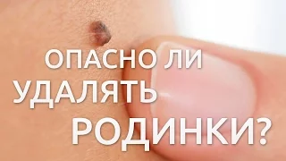 Опасно ли удалять родинки?