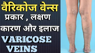 वैरिकोज वेन्स (उभरी हुई नसे) || Varicose veins explained in Hindi || MedHealth Support