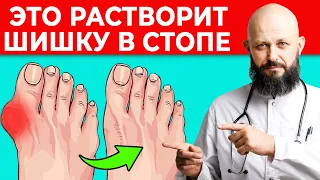 Шишка на стопе исчезнет за 1 неделю! || Косточка на ноге лечится без операции!