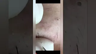 Ultimate Blackhead Extraction: Watch in Satisfaction as Pores are Purged!