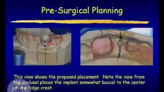 DENT 718: Implant-supported dentures