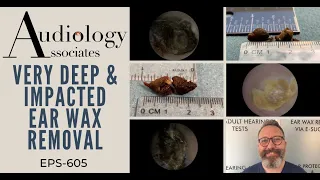 VERY DEEP & IMPACTED EAR WAX REMOVAL - EP605