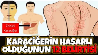 12 Belirti Karaciğerinizde Sorun Olduğunu Gösterir!