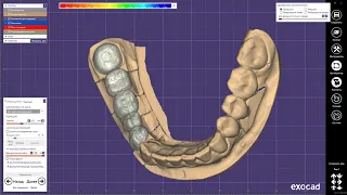 EXOCAD Моделировка каркаса под металлокерамику