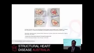 Percutaneous interventions for the tricuspid valve - Prof Darren Walters