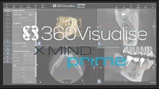 Acteon XMIND Prime General CBCT Overview of AIS 3D software