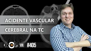 ACIDENTE VASCULAR CEREBRAL NA TOMOGRAFIA