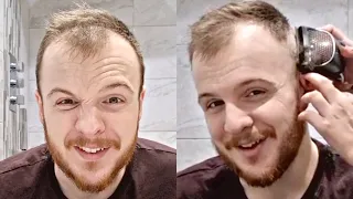 BALDING RECEDING Hairline 0 Buzz Cut Transformation At 24