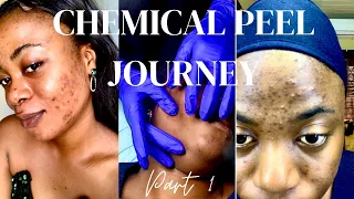 🎄Vlogmas day 1 |CHEMICAL PEEL full process | Appointment, Procedure, Cost etc