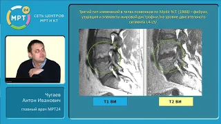 МРТ диагностика дегенеративно-дистрофических заболеваний позвоночника