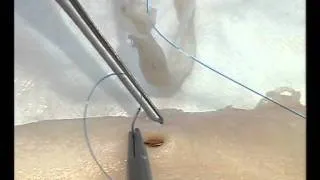 Cardiac Surgical Skills Laboratory - Proximal Anastamosis Parachute Technique CABG