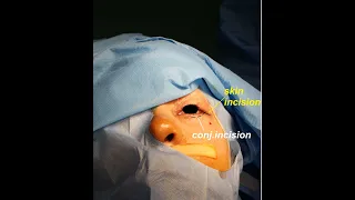 Transconjunctival canthotomy and cantholysis..Dr Talib H.Abbas   د طالب حيدر