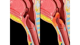 Epiglottitis