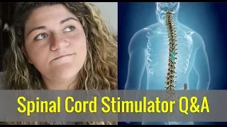 My Nevro Spinal Cord Stimulator Q&A (How does it work?!!) | Young Chronic Pain [CC]