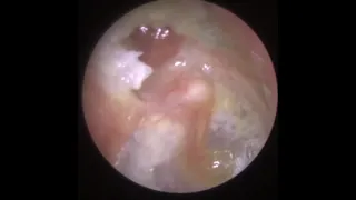 777 - Cholesteatoma & Ear Pus