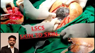 CESAREAN SECTION (SKIN TO SKIN) IN A PATIENT WITH PREVIOUS  LSCS WITH VOICE OVER.