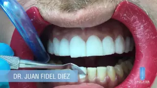 Unilaser | Diseño de Sonrisa paso a paso