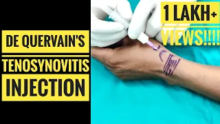 De Quervain's Tenosynovitis Injection Technique