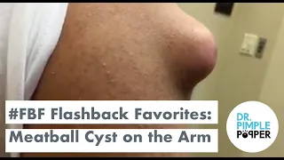 Flashback Favorites: Meatball Cyst on the Shoulder!