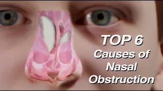 Top 6 Causes of Nasal Obstruction (Mouth Breathing)