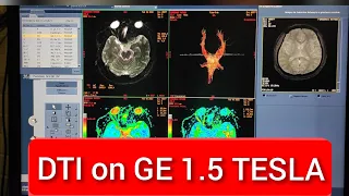 Diffusion Tensor Imaging (DTI) protocol, positioning and planning | Live Demo in English.