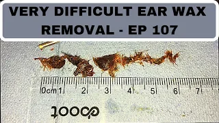 VERY DIFFICULT EAR WAX REMOVAL - EP 107