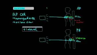 Types of Chest X-Rays part 1 - AP vs PA [UndergroundMed]