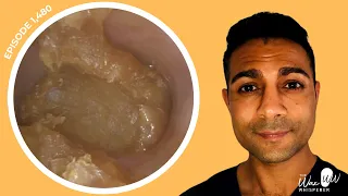 1,480 - Chronic Yearly Build-up of Ear Wax Removed | Listen to Learn about Hearing Pathway