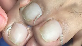 huge ingrown toenail removal